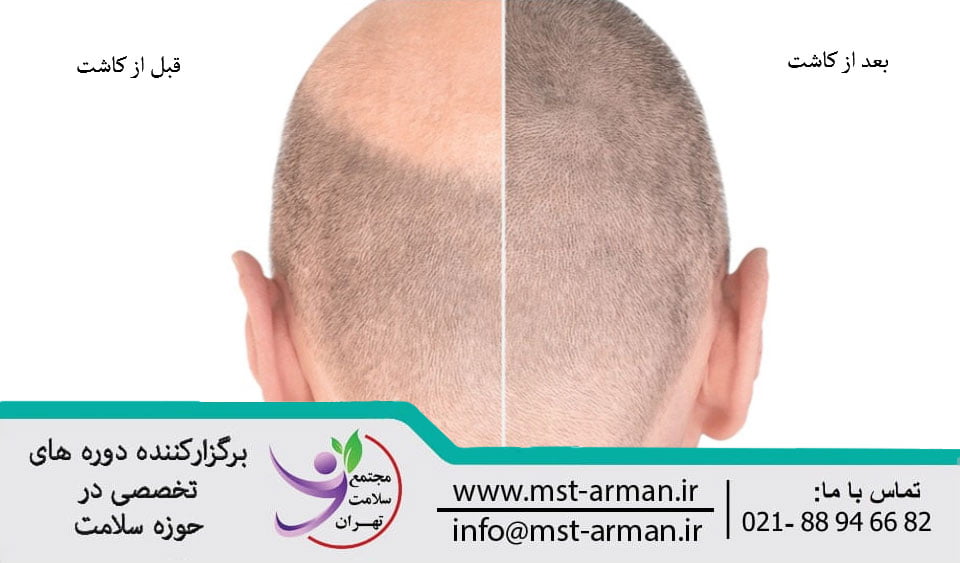 The cause of facial swelling after hair transplant | علت تورم صورت بعد از کاشت مو