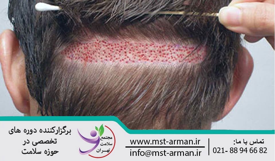 The effect and scar in hair transplantation | اثر و جای زخم در عمل کاشت مو