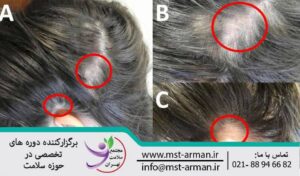 Traction alopecia | آلوپسی کششی