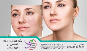 Classification of acne | طبقه بندی آکنه