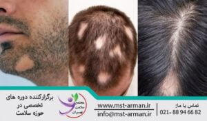 Alopecia hair loss | ریزش مو آلوپسی