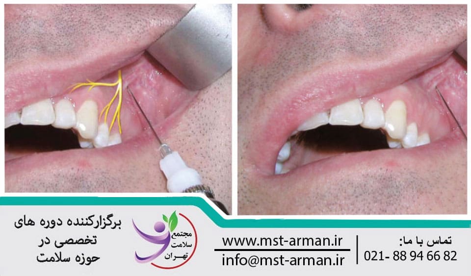 Anesthetic injection site in the inner lip | محل تزریق بی حسی در لب