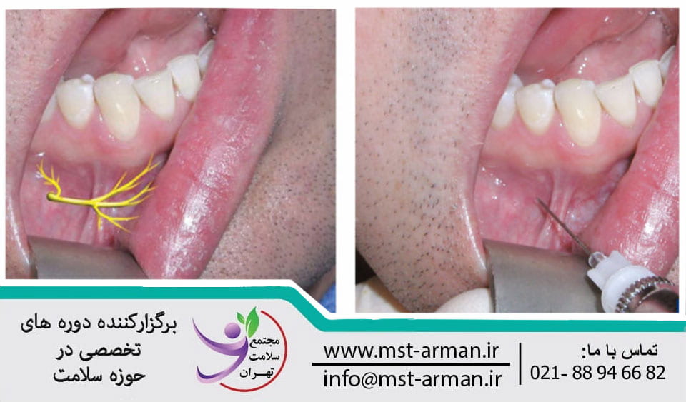 Anesthetic injection site in the inner lip | محل تزریق بی حسی در پایین لب