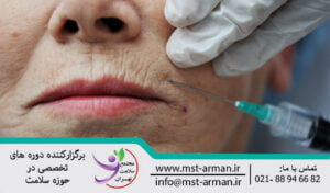 درمان ناحیه بالای لب با فیلر درمی | Treatment of upper lip area with dermal filler