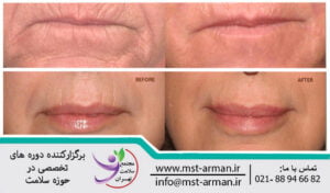 درمان ناحیه بالای لب با فیلر درمی | Treatment of upper lip area with dermal filler