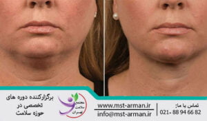 Ghabghab lipolysis | لیپولیز غبغب