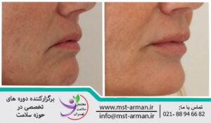Increasing chin volume with dermal filler | افزایش حجم چانه با تزریق فیلردرمی