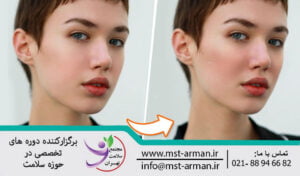گونه گذاری و افزایش حجم گونه با فیلر | Cheek formation and cheek volume increase with filler