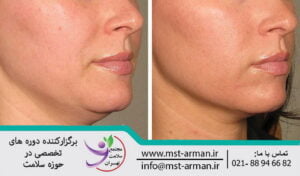 Lifter in mesotherapy | جوان ساز و لیفت کننده در مزوتراپی