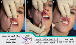 Lip ring nerve block procedure | تزریق بی حسی برای فیلر لب