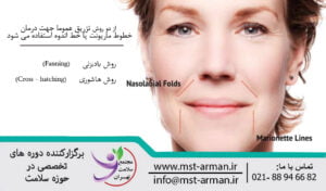 Marionette filler injection learning | آموزش فیلر خط اندوه
