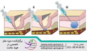 مکانیسم عمل فیلرهای درمی | Mechanism of action of dermal filler
