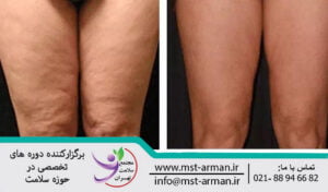 Removal of local obesity and cellulite | رفع چاقی و سلولیت 