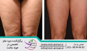 Removal of local obesity and cellulite | رفع چاقی و سلولیت