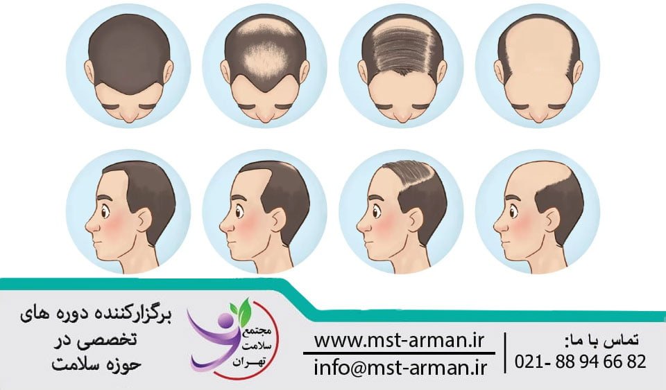 Types of hair loss | انواع ریزش شایع مو