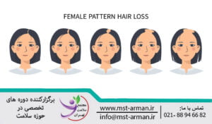 Classification of hair loss | طبقه بندی انواع ریزش مو