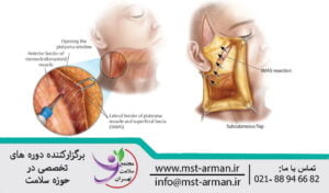 Diagnosis of deep fascia plate and parotid capsule | تشخیص صفحه فاسیای عمقی و کپسول پاروتید