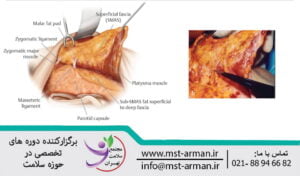 Identification of the plane between superficial and deep fascia | شناسایی صفحه بین فاسیای سطحی و عمیق