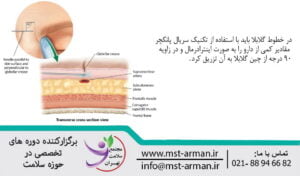 Important points in the glabellar region | نکات مهم در منطقه گلابلار | آناتومی نواحی مرتبط با پیشانی و گلابلار