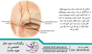 Major neurovascular structures in the glabella region | ساختارهای عصبی عروقی اصلی در ناحیه گلابلا | نکات کلیدی در تزریق فیلر در ناحیه گلابلار