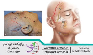 Safety considerations in dangerous areas of facial nerves | شاخه های سطحی اعصاب فرونتال