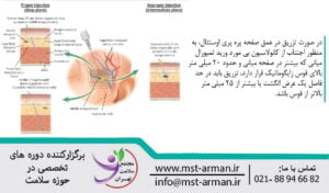 Superficial injection in the temporal region | تزریق سطحی در ناحیه تمپورال