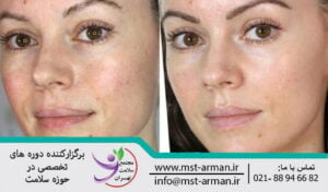 مراقبت های بعد از میکرونیدلینگ | Care after micro needling