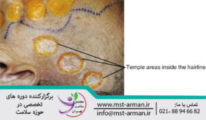 Appearance of the temporal region |یافته ظاهری ناحیه گیجگاهی