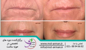 Botox around the lips | عوارض بوتاکس در نواحی اطراف لب