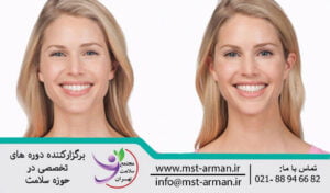 بوتاکس در نواحی پنجه کلاغی چشم | Botox crow's feet lines