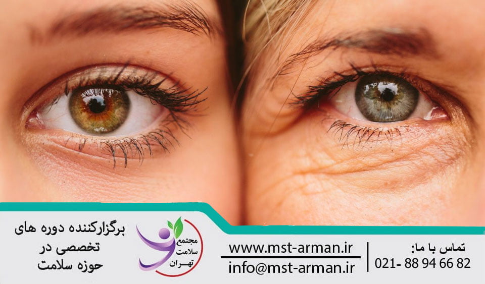 Botox lower eyelid wrinkles | تزریق بوتاکس چروک های پلک تحتانی