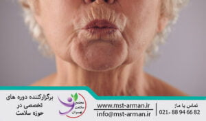 Botox in the areas of lip lines | عوارض بوتاکس در نواحی اطراف لب
