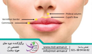 Botox in the lip areas | تزریق بوتاکس در نواحی اطراف لب