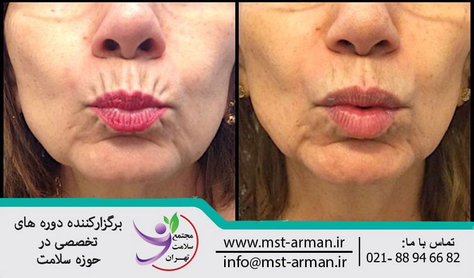Botox in the lip areas | تزریق بوتاکس در نواحی اطراف لب