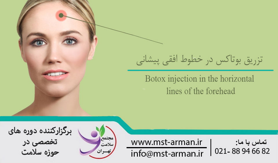 Botox injection in the horizontal lines of the forehead | تزریق بوتاکس در ناحیه پیشانی