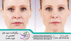 درمان خطوط ماریونت | Botox marionette