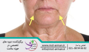 Botox marionette lines | بوتاکس خطوط ماریونت
