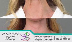 تزریق بوتاکس در خطوط نوار گردن | Botox neck band