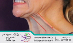 Treatment of neck lines with Botox | درمان خطوط گردنی با بوتاکس