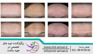 Changes of Botox injection in the forehead | تغییرات قبل و بعد بوتاکس در پیشانی
