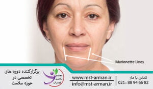 Complications of botox injection-marionette lines | عوارض تزریق بوتاکس خطوط ماریونت