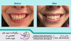 Complications of gummy smile Botox | عوارض بوتاکس لبخند لثه ای