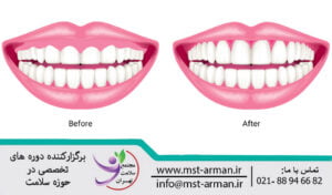 Gum smile botox | لبخنده لثه نما چیست