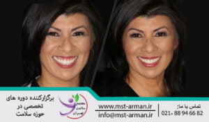 Gummy smile treatment with Botox | درمان لبخند لثه نما