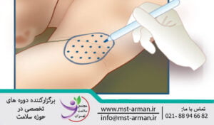 نواحی تزریق بوتاکس در زیر بغل | Botox injection areas in the armpits