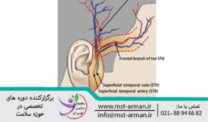 Location of the superficial temporal artery in the temporal region | محل شریان تمپورال سطحی در ناحیه گیجگاهی
