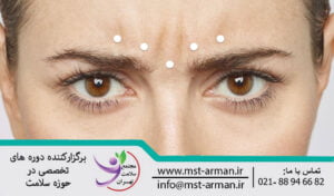 روش تزریق بوتاکس در خطوط اخم | Botox injection method in frown lines
