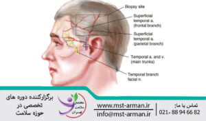 The course of the superficial temporal artery | مسیر شریان تمپورال 