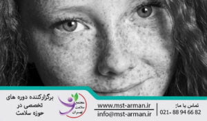 Treatment of hyperpigmentation | درمان هیپرپیگمانتاسیون