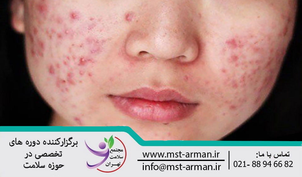 Treatment of inflammatory and non-inflammatory acne | درمان آکنه التهابی و غیر التهابی
